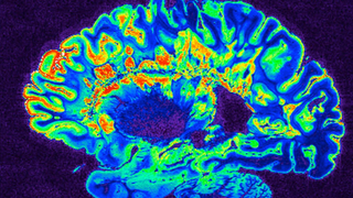 Experimental Drug Offers a 'Glimmer of Hope' for People With a Devastating Form of Multiple Sclerosis<em></em>